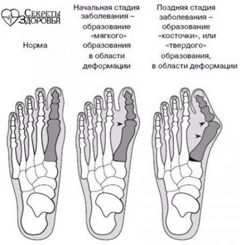 Какие симптомы сопровождают косточку на ноге?