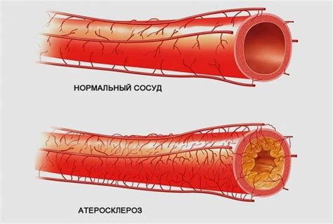 Какое влияние оказывает гипертония на проблему лопающихся сосудов