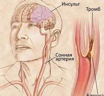 Как бороться с постоянным шумом в голове