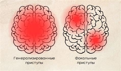 Как возникает эпилепсия у подростков?