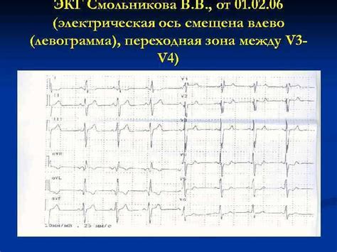 Как диагностировать неполную блокаду на ЭКГ?