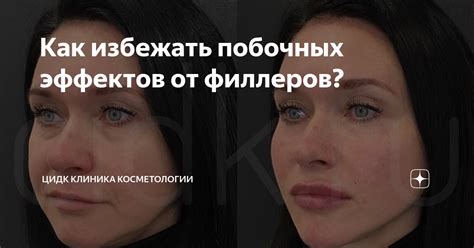 Как избежать побочных эффектов от выдавливания прыщей