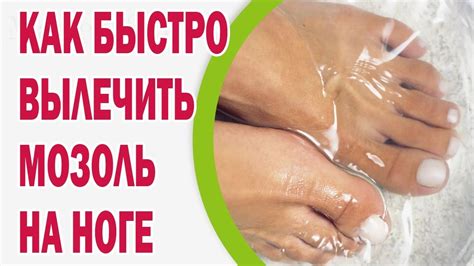 Как лечить водяные мозоли на ноге?