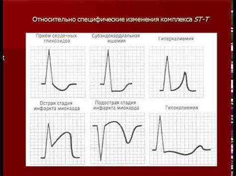 Как лечить нарушение реполяризации при синусовом ритме?