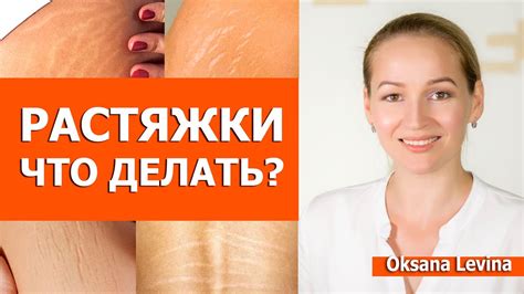 Как лечить растяжки на ногах?