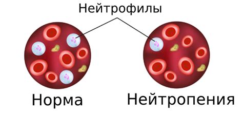 Как поднять количество нейтрофилов до нормы