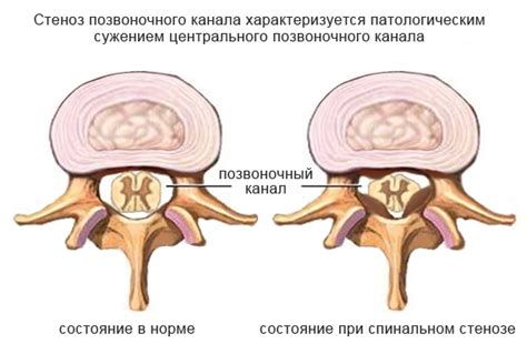 Как предотвратить образование шишки в поясничном отделе позвоночника