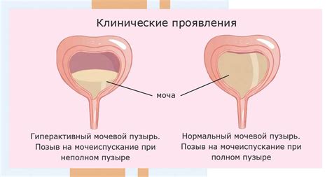 Как предотвратить снижение гипоксии детрузора мочевого пузыря