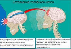 Как предотвратить сотрясение мозга?