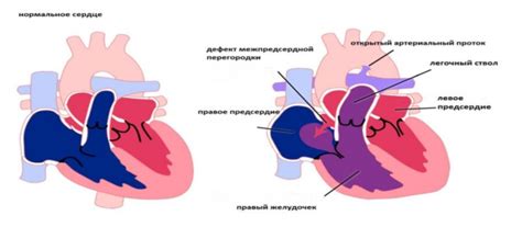 Как проводится диагностика межпредсердной блокады?