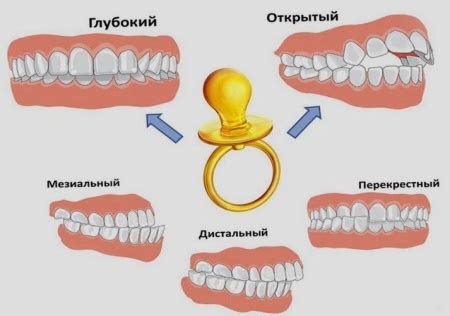 Как разобраться с неправильным прикусом новорожденного