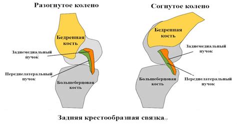 Как распознать ангуляцию задней крестообразной связки