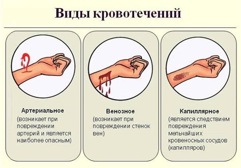 Как установить давящую повязку для остановки кровотечения