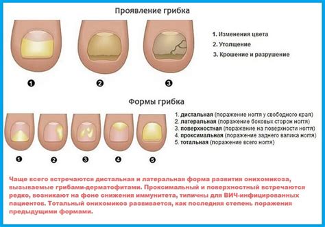 Как устранить проблему надломанного ногтя