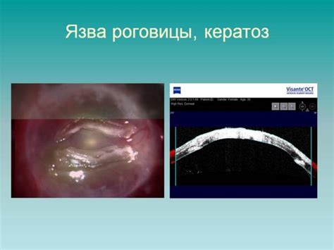 Кераторефрактометрия в диагностике и контроле состояния роговицы