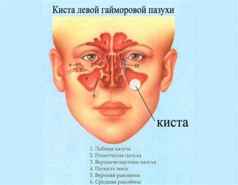 Киста в носовой пазухе: причины, симптомы и методы лечения