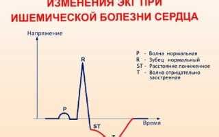 Клинические проявления и диагностика нарушений реполяризации