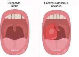 Когда следует обратиться к врачу при першении в горле у ребенка