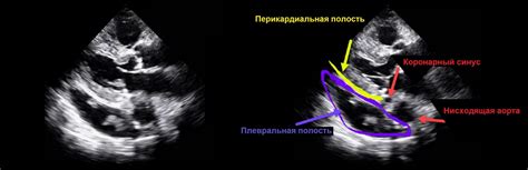 Количество жидкости в перикарде: нормальные значения