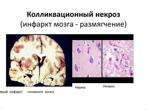 Колликвационный некроз: причины и особенности