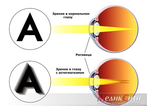 Коррекция астигматизма