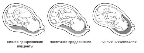 Краевое загибание и его причины