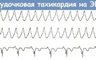 Купирование приступа тахикардии в домашних условиях