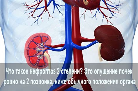 Левосторонний нефроптоз 2 степени - что это?