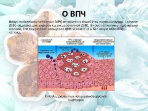 Лечение ВПЧ 35 у женщин