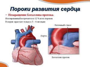 Лечение баталов протока