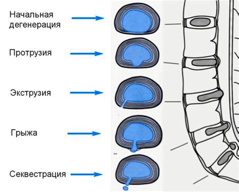 Лечение выбухания дисков