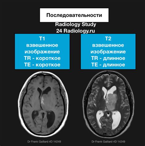 Лечение гипоинтенсивного сигнала на Т1