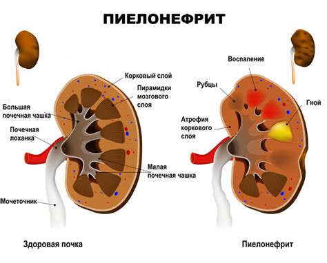 Лечение дергания почки справа