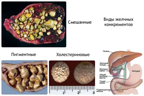 Лечение камней в желчном пузыре