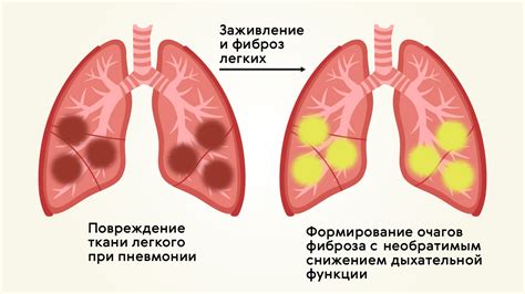 Лечение пневмонии и воспаления легких