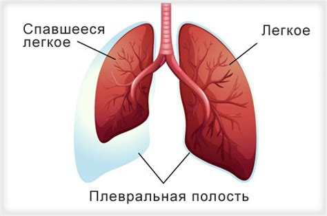 Лечение пневмоторакса