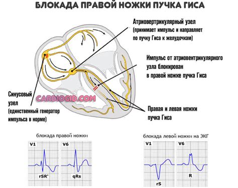 Лечение полной блокады левого пучка Гиса