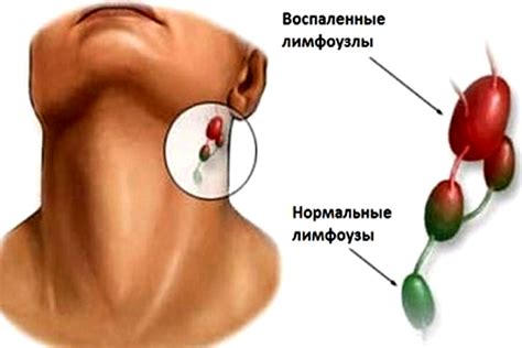 Лечение простуды лимфоузлов на шее