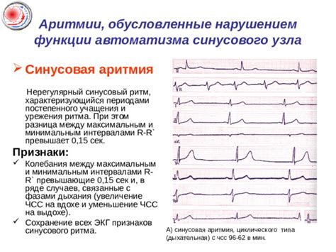 Лечение синусового нерегулярного ритма с ЧСС