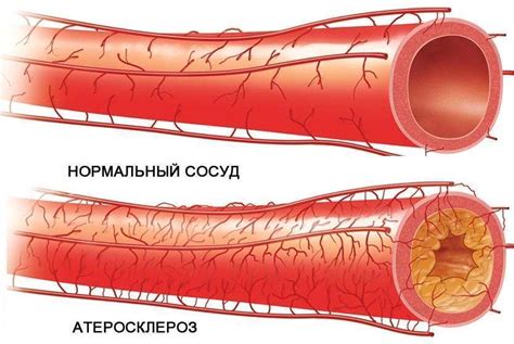 Лечение склероза аорты легких