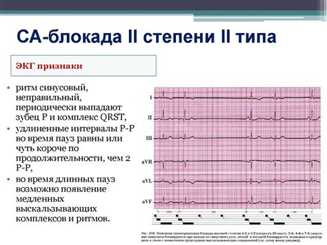 Лечение транзиторной са блокады 2 степени