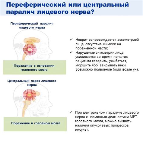 Лечение центрального паралича лицевого нерва