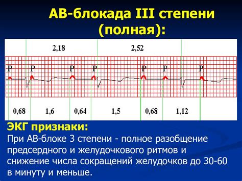 Лечение Av блокады i iii степени