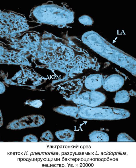 Лечение Klebsiella pneumoniae в посеве