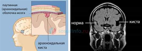 Ликворная плотность головного мозга