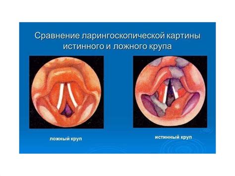 Ложный круп у детей: причины, симптомы и диагностика