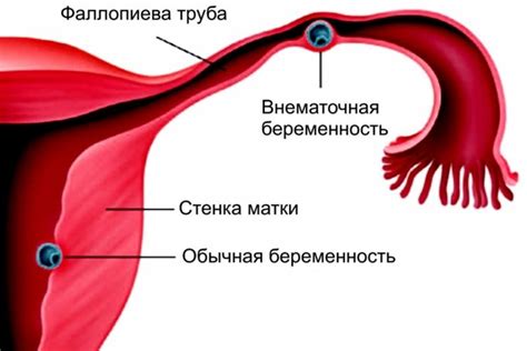 Маточная беременность: симптомы, диагностика и лечение