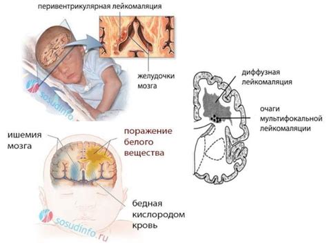 Медицинские методы предотвращения гипоксии головного мозга у ребенка