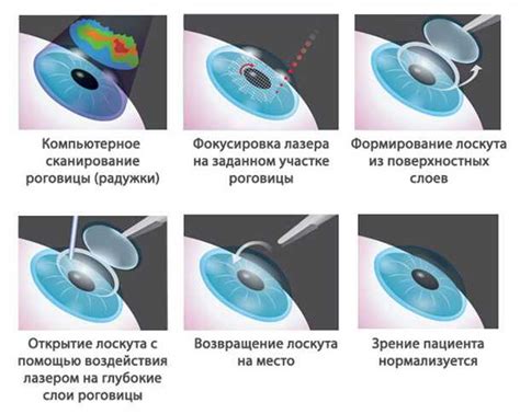 Методика коррекции зрения фемто ласик: преимущества и эффективность