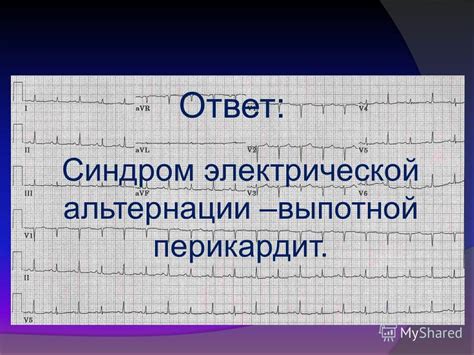 Методы выявления электрической альтернации на ЭКГ